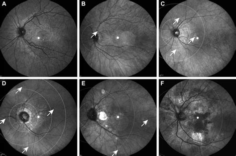 The Extent Of Angioid Streaks Correlates With Macular Degeneration In