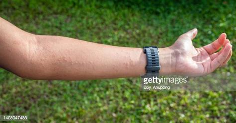 Red Rash Arm Foto E Immagini Stock Getty Images