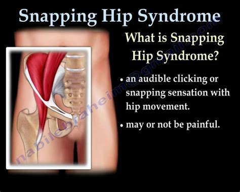 Snapping Hip Syndrome Everything You Need To Know Dr Nabil