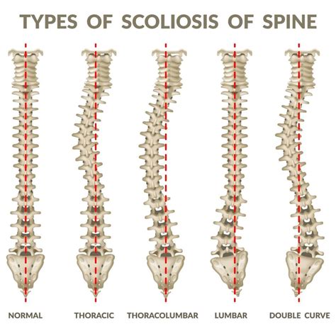 Chiropractic Care And Scoliosis Alternative Health Center Of The