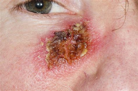 Basal Cell Skin Cancer On Cheek Stock Image C0151229 Science