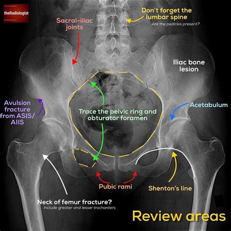 Methods of radiographic measurement of pelvic obliquity. 5,145 Likes, 82 Comments - The Radiologist ...
