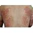 Severe Eczema Drug Approved By FDA Price Tag Is $37000 A Year  The