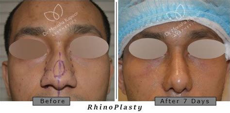 Best Rhinoplasty Surgeon Delhi Rhinoplasty Rhinoplasty Surgeon Nose Job