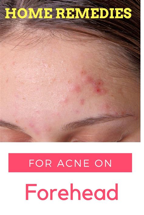 Get Acne Frequently On Your Forehead Try These Home Remedies