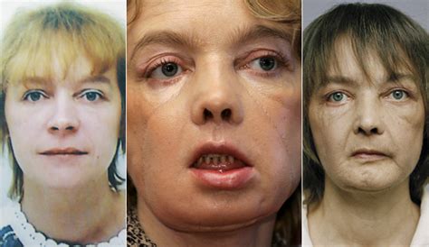 Pictures Of Face Transplant Before And After Charla And Isabelle Jdy Ramble On