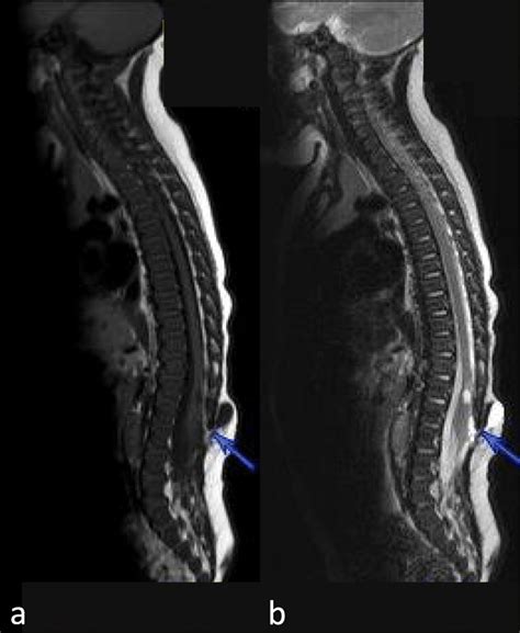 Whole Spine Sagittal T1 A And T2 Weighted B Mri Showing The Single