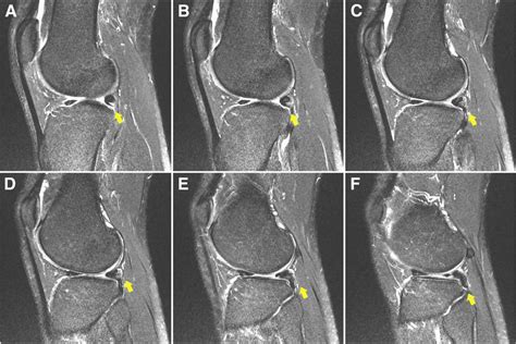 Consecutive Six Sagittal Cuts Of Mri T2 Weighted Imaging Show The