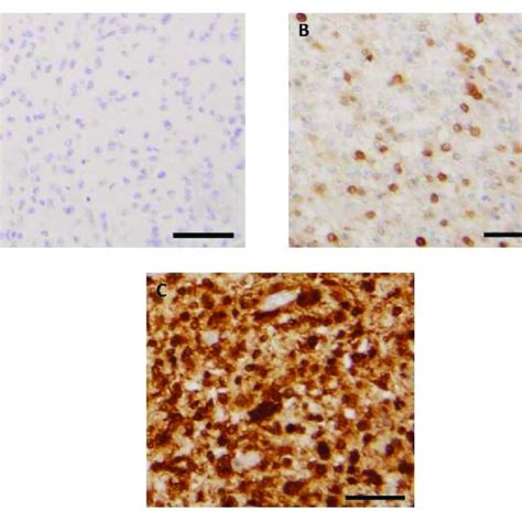 Representative Images Of Patterns Of P16 Immunohistochemical Staining