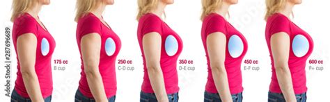 How To Choose Breast Implants Different Types And Sizes Of Breast