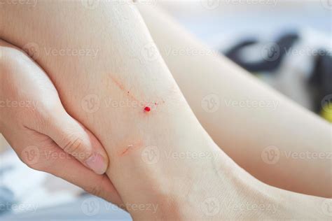 Bleeding wound on ankle caused by cat bite. 9399028 Stock Photo at Vecteezy