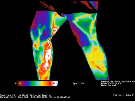 Medical Thermal Imaging The Natural Health Practice