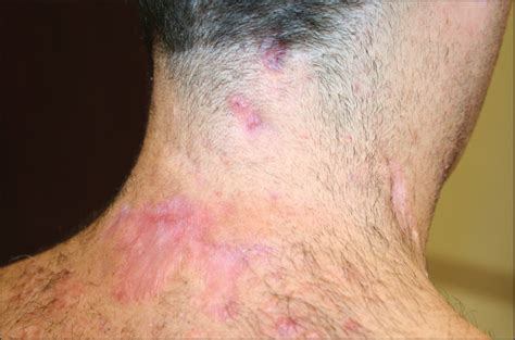 Atypical Hidradenitis Suppurativa Involving The Posterior Neck And