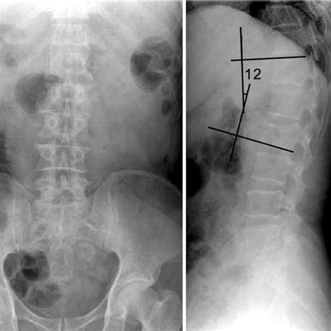 Radiographs Show Anterior Compression And Kyphosis Of L Vertebral Body