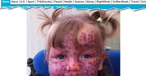 Doença Rara Deixa Criança Com Manchas Na Pele E Causa Convulsões