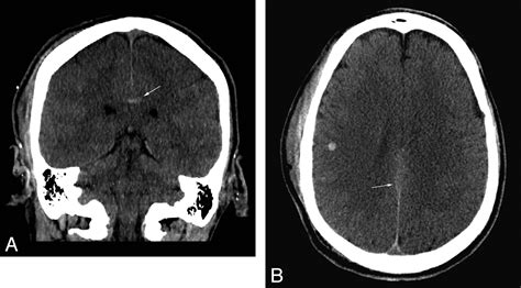 Value Of Coronal Reformations In The Ct Evaluation Of Acute Head Trauma