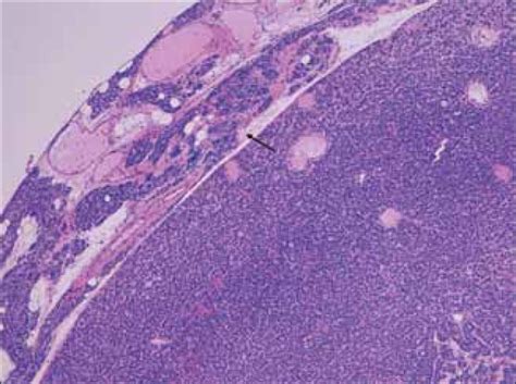Parathyroid Adenoma Histology