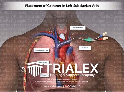 Placement Of Catheter In Left Subclavian Vein Trialexhibits Inc