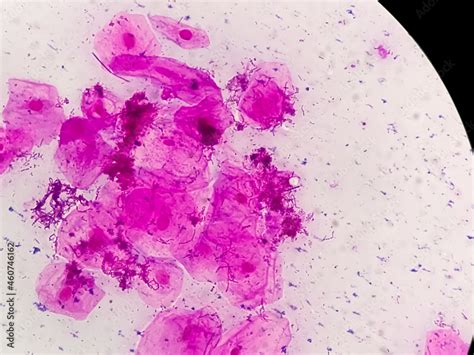 High Vaginal Swab Gram Stain Microscopic 100x Show Few Pus Cells And