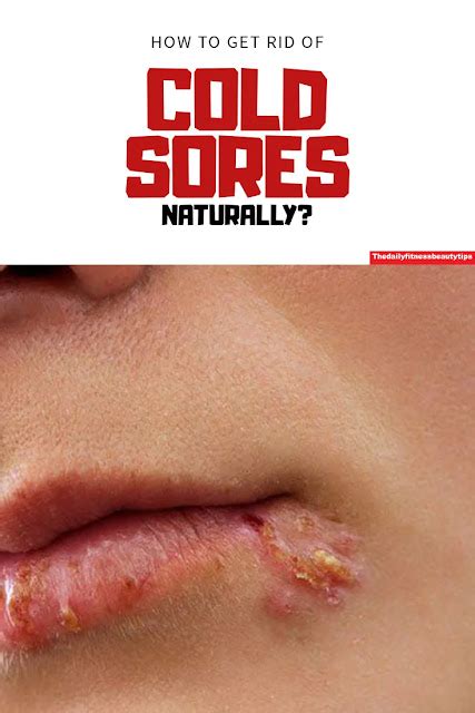 How To Get Rid Of Cold Sores Naturally