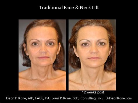 Facial Procedures Dr Dean Kane Center For Cosmetic Surgery And Medispa
