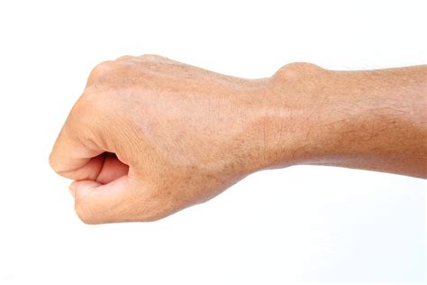 Ganglion Cysts Of The Hand And Wrist Arlington Orthopedics Associates