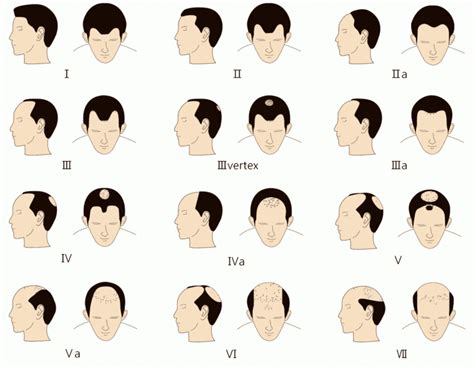 Receding Hairline Stages Signs Treatment