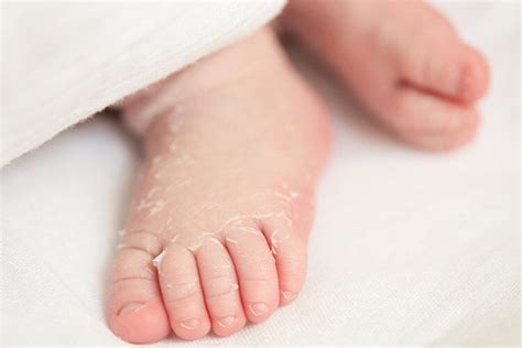 Newborn Skin Peeling What To Do And When To Worry Mums Grapevine