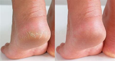 Image Before And After Treatment Of Dry Heels Cracks Skin Dehydrated Skin On Heels Of Female
