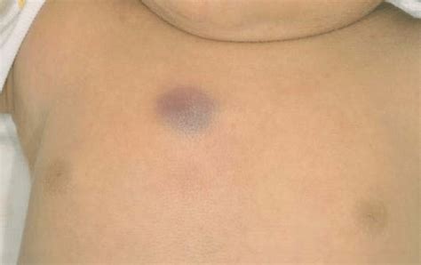 Red Violaceous Bruise Like Plaque 13 × 16 Mm In Size On The Right