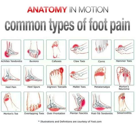 Heel Foot Pain Identifier Chart
