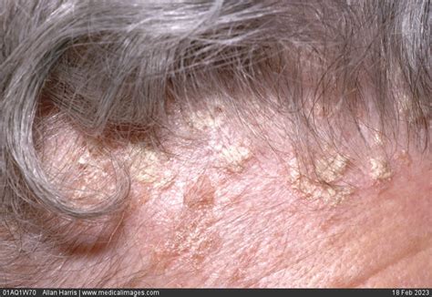 Stock Image Dermatology Mild Psoriais On Scalp Patches Of White Flaky