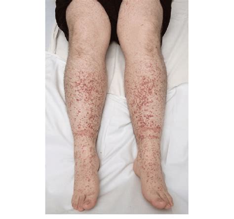 Top 96 Images Red Rash On Lower Legs Above Ankles Photos Updated