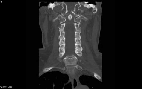 Occipital Condyle Fracture Radrounds Radiology Network