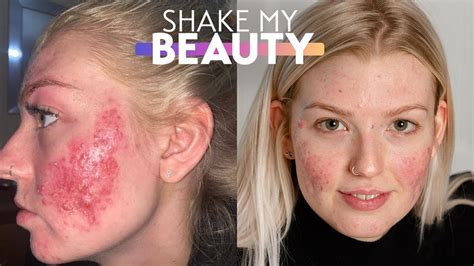 My Cystic Acne Is So Bad It Went Viral Shake My Beauty
