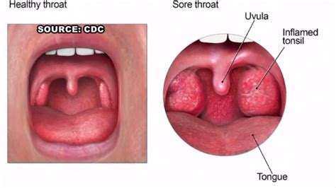 Strep Throat Is A Year Round Illness Here Are Symptoms To