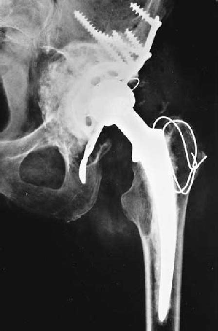 A Radiographs Showing Considerable Acetabular Bone Loss In A