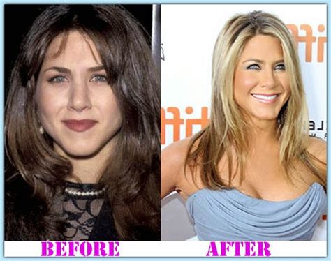 Plastic Surgery Before And After Jennifer Aniston Plastic Surgery
