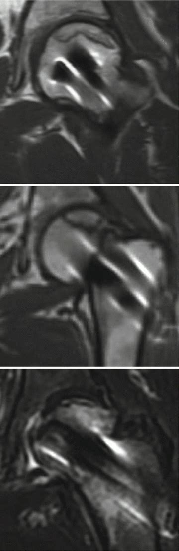 Posttraumatic Osteonecrosis Of The Femoral Head Radiology Key