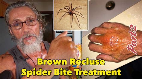 Brown Recluse Spider Bite Treatment Earther Academy