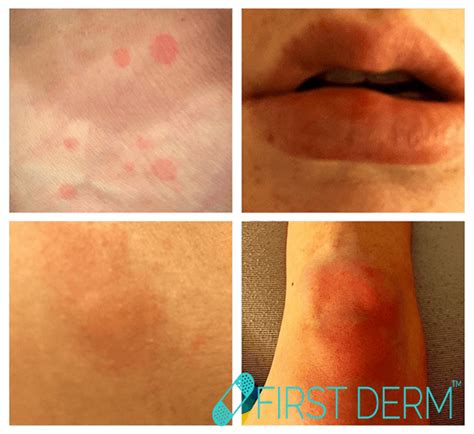 Online Dermatology Itchy Red Rash And Spots On Your Skin What Could