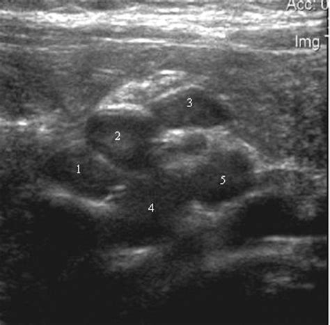 Para Aortic Lymph Nodes Ultrasound Ultrasound Images In Case 1 With A