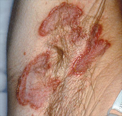 Erythematous Plaques On The Flexural Surfaces—quiz Case Dermatology