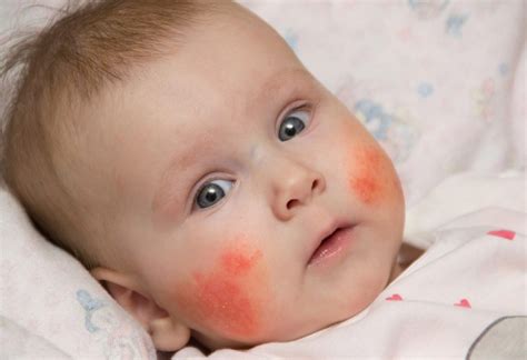 Tips For Parents To Manage Childrens Eczema Pittsburgh Parent
