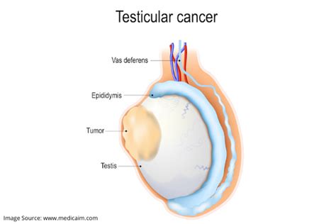 Testicular Cancer Lump On Scrotum