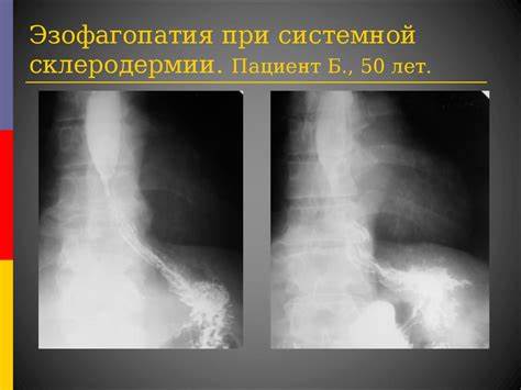 Диета при склеродермии системной Заболевания пищевода. Ахалазия кардии. Эзофагопатия при системной Заболевания пищевода. Ахалазия кардии. Эзофагопатия при системной Диета при склеродермии системной