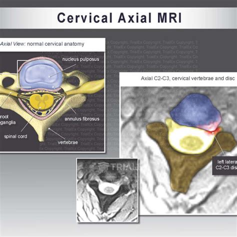 Cervical Mri Trialexhibits Inc 361
