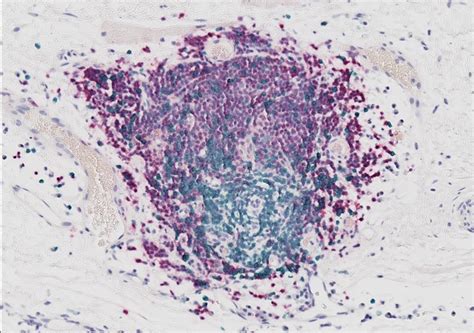 B cells representing various stages of differentiation/maturation have been examined, using normal cells, leukaemia cells. Les lymphocytes B : de nouveaux alliés pour le traitement ...