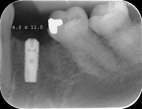 Dentsply Sirona Osseospeed S Astra Tech Implante Dentário Spotimplant