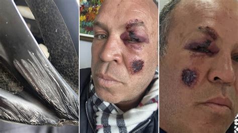 terrible accidente automovilístico de una leyenda de la ufc sufrió varias heridas en el rostro